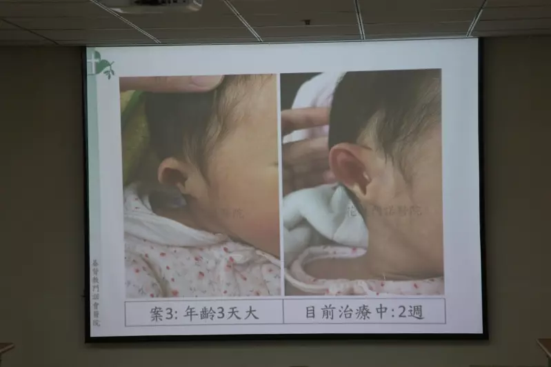 新生兒耳朵變形 出生一周快矯正