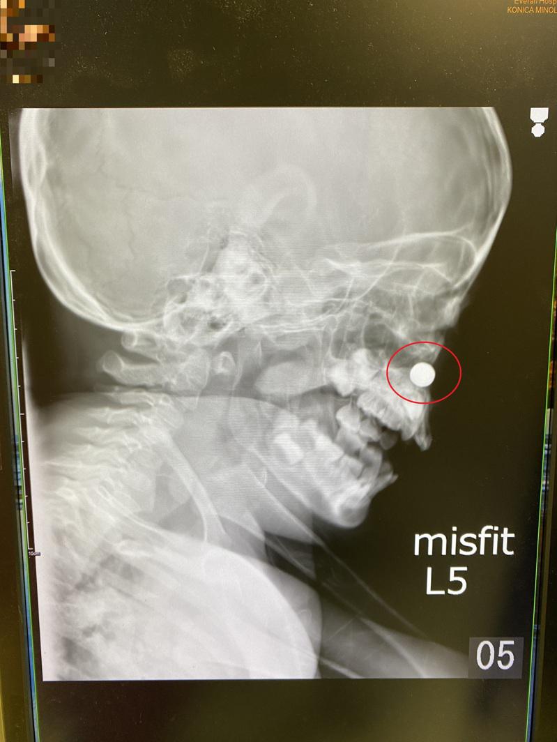 一名男童右侧鼻子发现有一颗钮扣电池卡在鼻孔里面，所幸早拿出，避免了电池中的毒物进一步伤害男童的鼻腔。（图：长安医院提供）