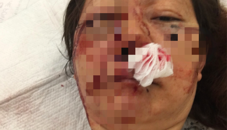家人公布的邓女士伤势照片。（取自Gofundme）