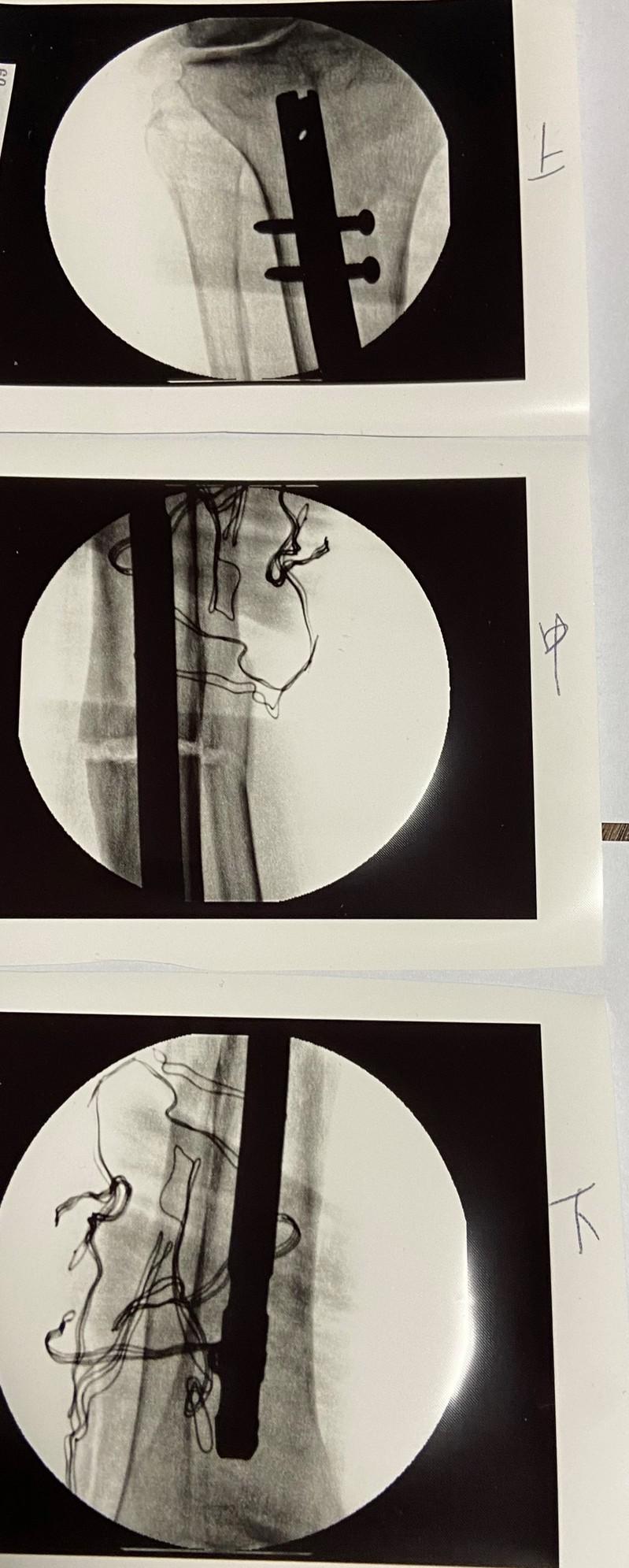 李姓男子44年前車禍，右腿腿骨癒合不良外翻，被誤為右膝不堪使用，經手術矯正已復位，不必換置人工膝關節。(圖：員榮醫療體系提供)