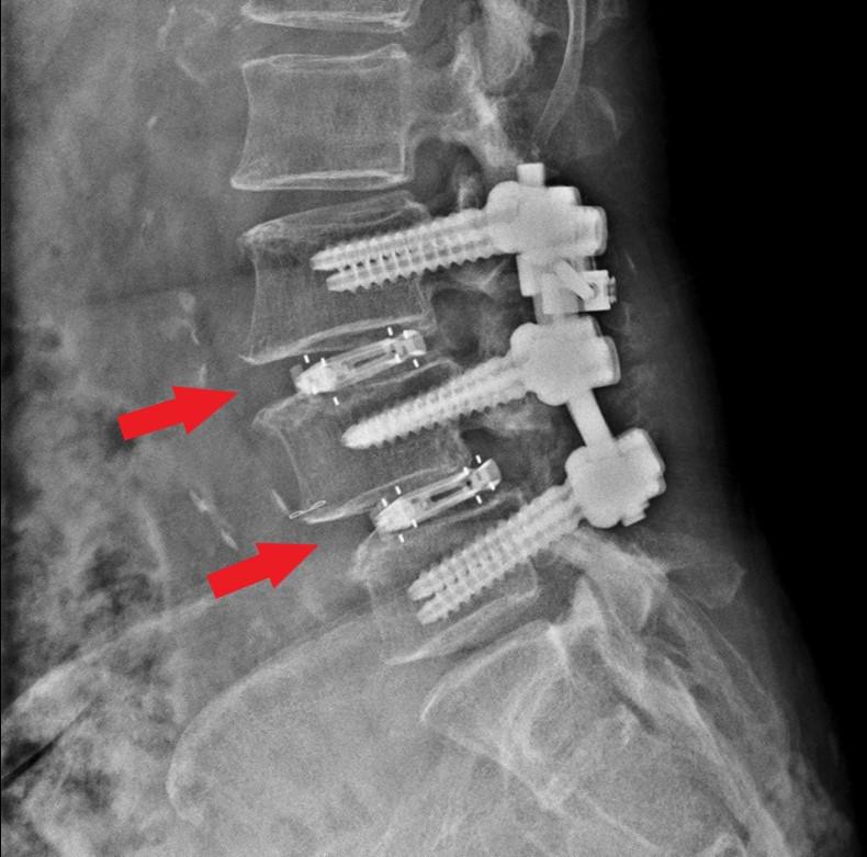 婦人接受一次性手術置入兩組新式撐開式支架，治療連續椎間盤突出併脊椎滑脫症。(記者吳慧芬／翻攝)